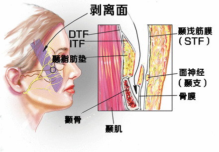 筋膜上平面和骨膜下平面的过渡区:从侧面看,剥离面始于颞深筋膜上