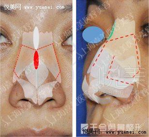 截骨术后,可以起到两方面的作用,一为闭合开放的鼻顶.