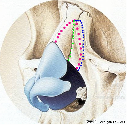 一,宽鼻的解剖基础: 1,正常的骨性鼻拱由对称性的鼻骨及上颌骨鼻突