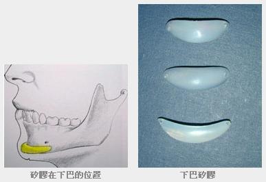 硅胶垫下巴手术示意图